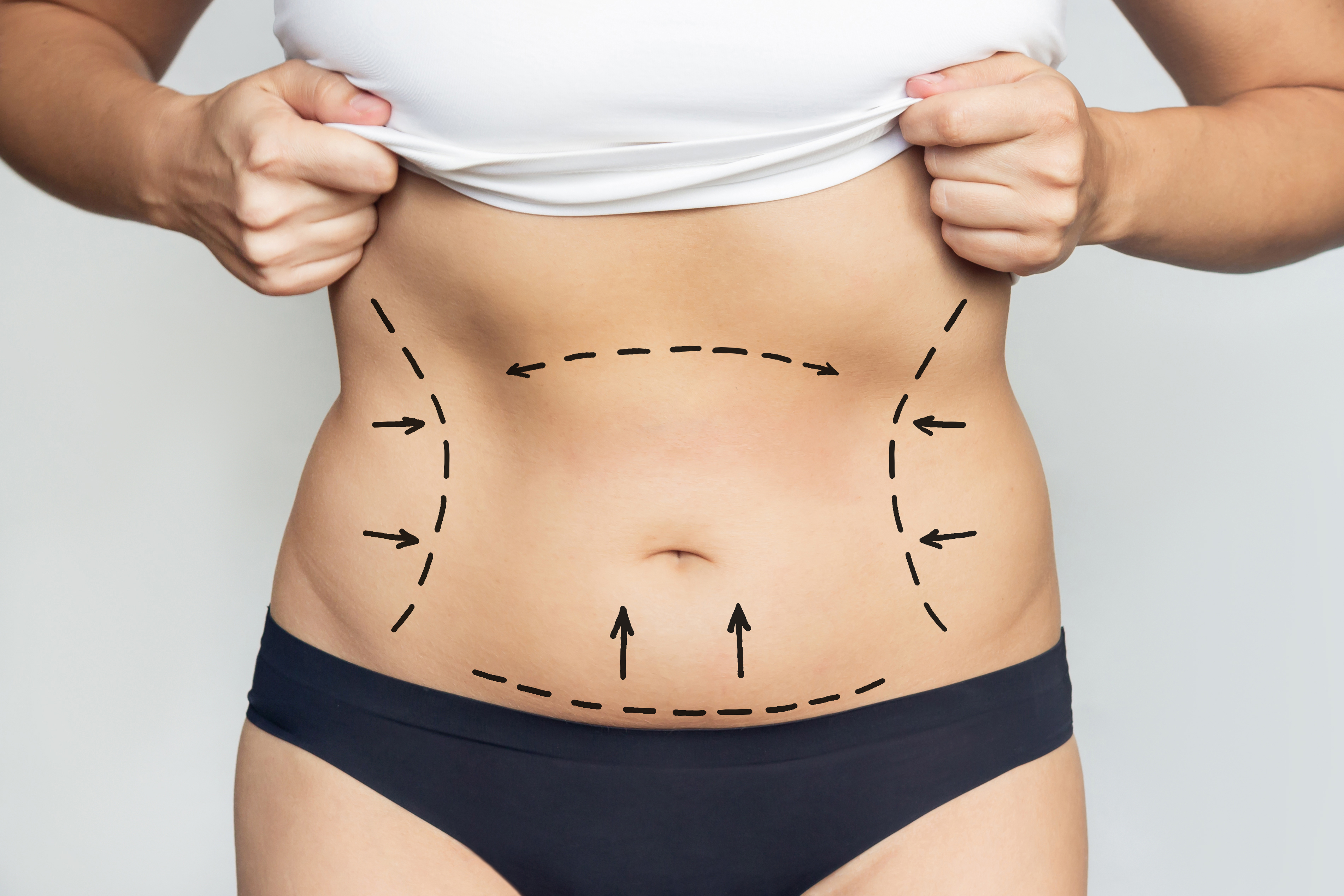 Abdominoplastia